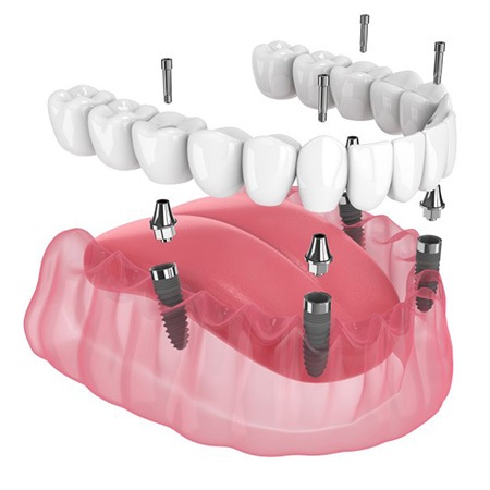 a 3D example of All-on-4 dental implants