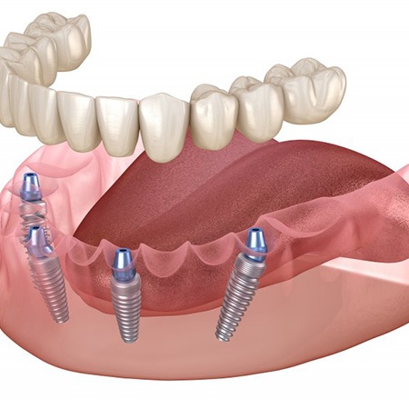 a 3D illustration of All-on-4 dental implants