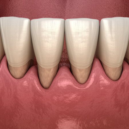 Patient with gum recession from gum disease