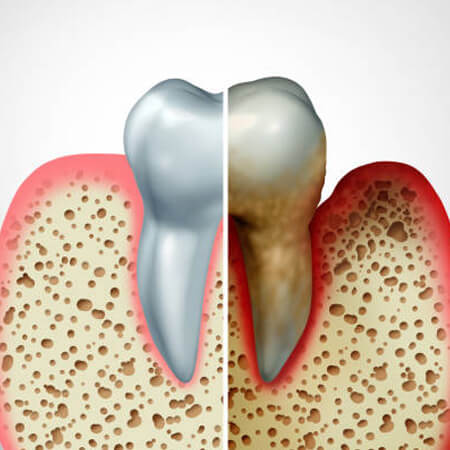 Comparison of healthy and infected gums