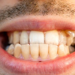 Patient in Fresno with crowded teeth who can use Invisalign