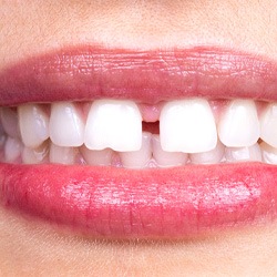 Patient in Fresno with gapped teeth who can use Invisalign