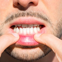 Patient in Fresno with underbite who can use Invisalign