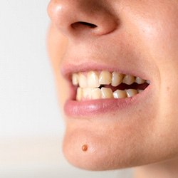 Patient in Fresno with crossbite who can use Invisalign