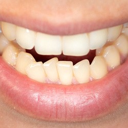 Patient in Fresno with open bite who can use Invisalign